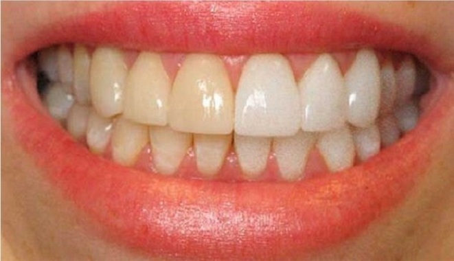 6 продуктов, которые приводят к желтизне зубов
